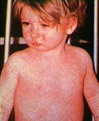Measles from 0 to 603–an Evolve Urgent Care Alert